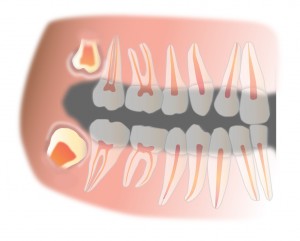 Germenes tercerso molares