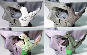 reconstruccion maxilofacial 3D