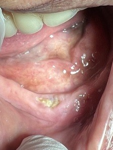 osteoquimionecrosis mandíbula