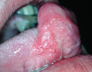 cáncer de borde lateral de lengua