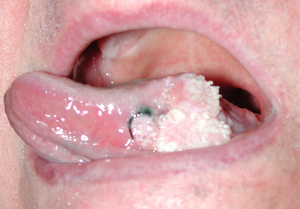 cancer de borde lateral de lengua