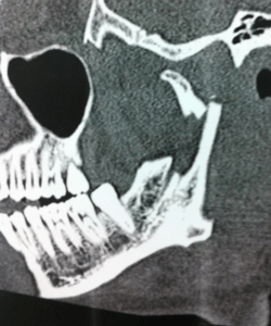 fractura de mandíbula