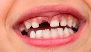 fractura dental en niños