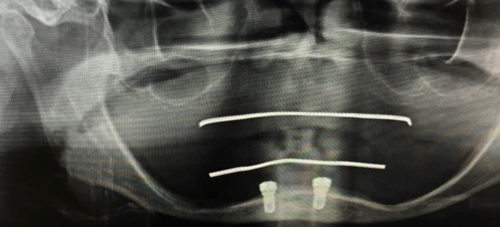 implantes en mandibula atrofica