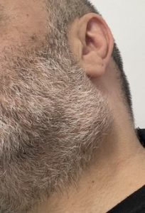 Tumor de glándula parótida izquierda.