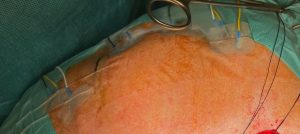 electrodos del neuroestimulador cubriendo las diferentes zonas de influencias de las ramas del nervio facial durante cirugia de tumor de parótida